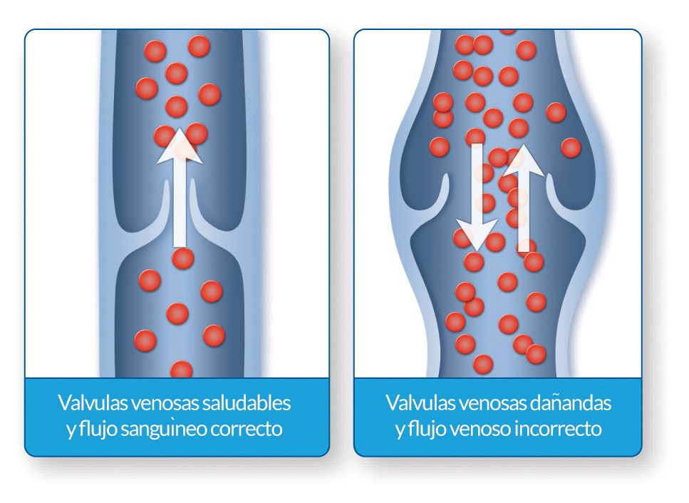 Spider vein treatment sclerotherapy Medical Vein Clinic San Antonio