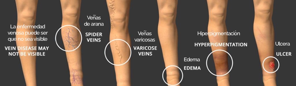 veins-2 veins-2