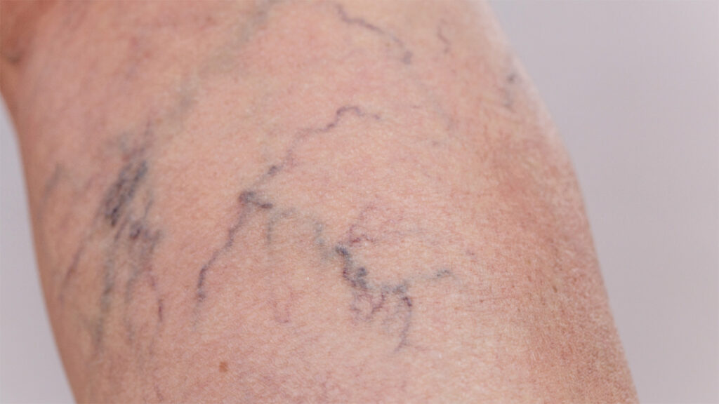 Understanding Varicose Veins: Causes, Progression, and Modern Treatment ...