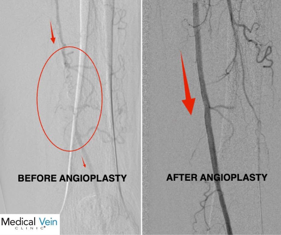 Angiogram images showing a severely occluded superficial femoral artery before angioplasty and full blood flow restored after treatment at Medical Vein Clinic San Antonio